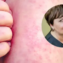 Dłoń drapiąca zaczerwienioną skórę z wysypką. W tle kobieta, być może cierpiąca na tę chorobę.