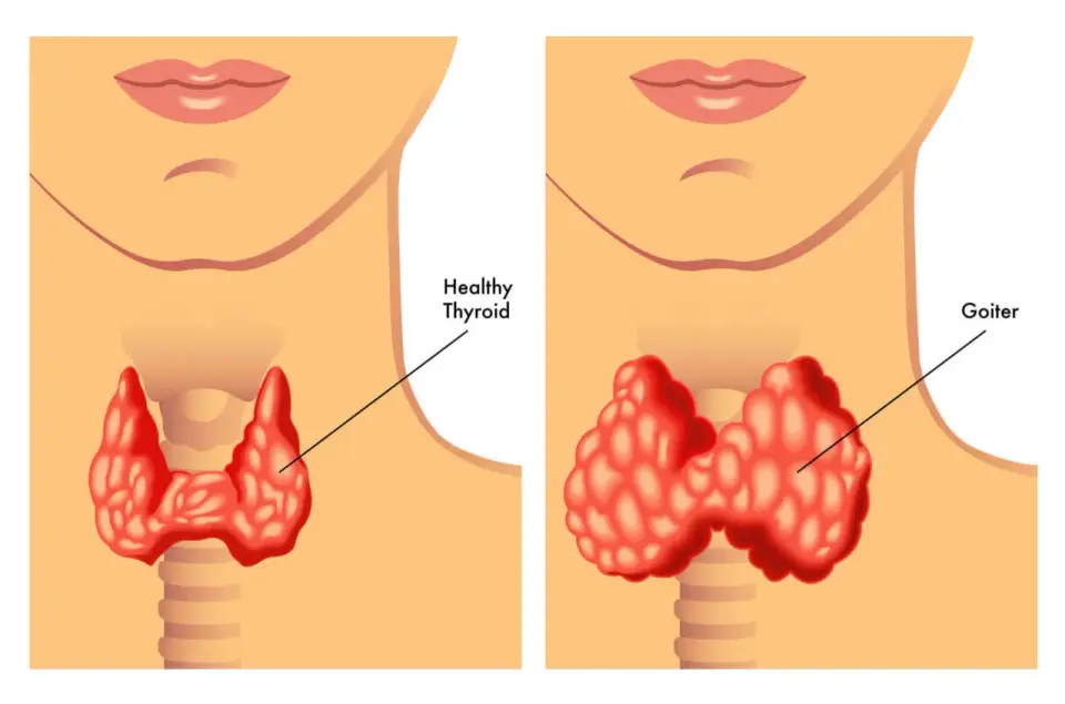 Wole tarczycy (goiter): przyczyny, objawy i skuteczne leczenie